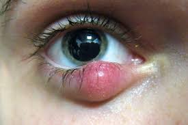Image result for milium cyst on eyelid