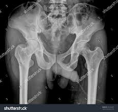 Image result for Hip XRay
