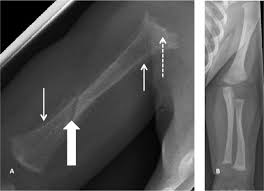 Metabolic Bone Disease Of Prematurity Causes Recognition Prevention Treatment And Long Term Consequences Adc Fetal Neonatal Edition