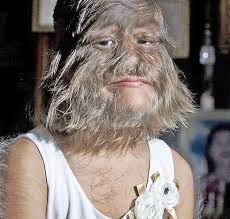 Image result for Hypertrichosis
