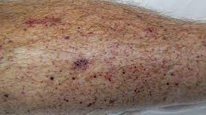 The source is oropharyngeal secretion. Is That A Mono Rash How To Know If That Rash Means Mono