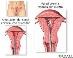 El término aborto espontáneo sugiere qué algo se hizo mal mientras se estaba embarazada. Spanish Hie Multimedia Dilatacion Y Legrado