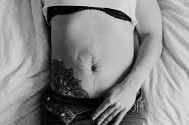 Eine operation ist nur dann erforderlich, wenn der nabelbruch beschwerden verursacht oder die bruchpforte größer als ein zentimeter ist. Bauchnabelbruch Rektusdiastase Operieren Oder Nicht Mama Moves