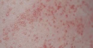 Heat Rash Pictures Symptoms Causes Treatments Heat Rash Itchy Rash Prickly Heat