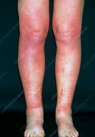 Image result for allergy rash on the legs