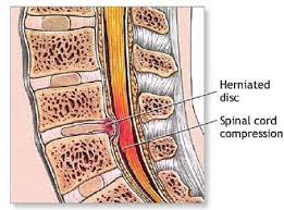 Atunci când durerile devin persistente, se ajunge la operaţie. Masajul In Hernia De Disc Operata Move Flex Gel In Romania