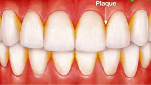 May 03, 2019 · cannon recommends that you: The Best Way To Remove Plaque From Teeth Monroe Family Dentistry