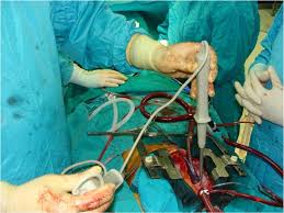 Defibrillator paddles are attached to the defibrillator by insulated leads. Combination Of Internal Epicardial And External Transthoracic Defibrillation During Heart Surgery Springerlink