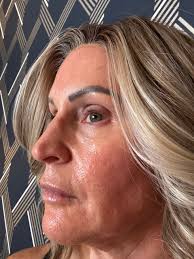 Alloy M4 + Tretinoin Face Creams Before & After Review