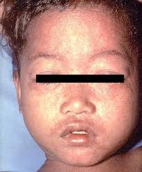 Differing amounts of fine branny desquamation may be seen. Photos Of Measles And People With Measles Cdc