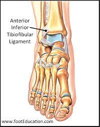 Ankle Sprains Orthopaedia