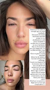 Qué le pasa a Ana Moya? La 'influencer' muestra los problemas de visión y  los fuertes dolores que está sufriendo