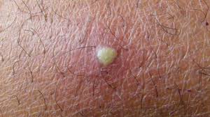 Cyst Vs Boil What Is The Difference Tips For Identification