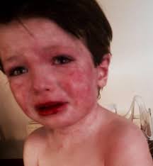 Boy's severe eczema that left his skin red raw and oozing pus is 'cured by  miracle treatment'