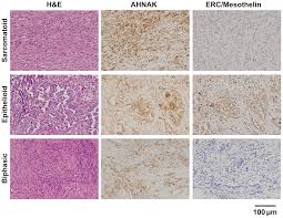 Early symptoms of mesothelioma are more often caused by other things, so at first people may ignore them or mistake them for common, minor ailments. Ahnak Is Highly Expressed And Plays A Key Role In Cell Migration And Invasion In Mesothelioma