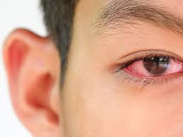 Penyebab dan cara menyembuhkan pembuluh darah mata pecah. Apa Benar Mata Merah Pertanda Gejala Virus Corona Ini Faktanya