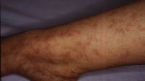 Some patients receive a combination of treatments. Radiation Dermatitis Causes Symptoms And 5 Treatment Methods