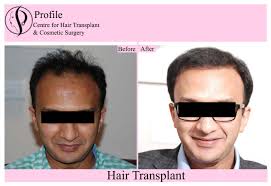 Get The Low Cost Hair Transplant Surgery From Profile Hair Transplant Centre That Is Induldged In Hair Transplant Hair Transplant Surgery Hair Loss Medication