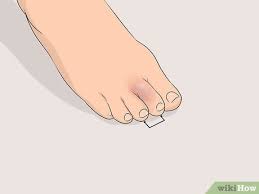 It usually happens from coming down on your ankle wrong, or rolling it. you will notice that with a sprained foot, you can still walk on it, but it is best to elevate it and put ice on it. How To Buddy Tape An Injured Toe 7 Steps With Pictures
