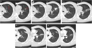 Nasopharyngeal cancer shouldn't be confused with other types. Value Of Ablation Therapy In The Treatment Of Lung Metastases Qi 2018 Thoracic Cancer Wiley Online Library
