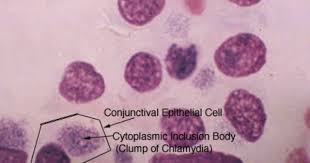 Disease Caused Chlamydia Bacterial Cause Chlamydia Trachomatis Http Banishchlamydia Com Hop 0 Disease Microscopic Optometry