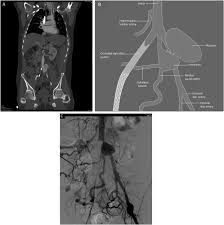 They support organs and other tissues throughout the body. Rupture Of A Median Sacral Artery Aneurysm In A Patient With Vascular Ehlers Danlos Syndrome Ejves Vascular Forum