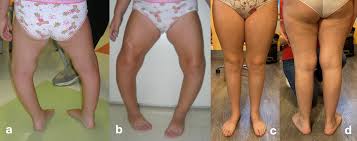 Image result for Genu Varum