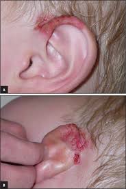 Image result for Intertrigo