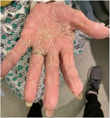 Image result for scabies norvegica