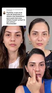 Reversão de intercorrências de preenchimento de olheira vindo de outro...