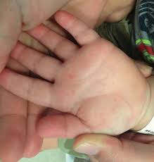 Antibiotics may be prescribed by your doctor if it's a bacterial case. Oral Lesions Pediatrics Harwood Nuss Clinical Practice Of Emergency Medicine 6 Ed