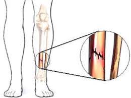 Vertebra servikalis atau ruas tulang leher berjumlah 7 ruas yang merupakan paling kecil. Rekomendasi Obat Tradisional Tulang Retak Kumparan Com