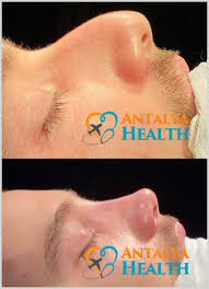 This procedure is commonly referred to as a nose job. Rhinoplasty Nose Job In Turkey Cosmetic And Plastic Surgery Center