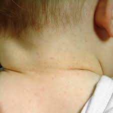 This can create purple spots on the skin that range in size from small dots to large patches. Purpuric And Petechial Rashes In Adults And Children Initial Assessment The Bmj