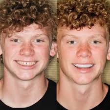 Amazing smile makeover transformed using 8 minimal prep porcelain veneers.  Congenitally had small teeth and spaces, was self-conscious of his smile.  Never again will he have to think twice about smiling. ​​​​​​​​