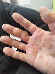 Image result for dyshidrosis