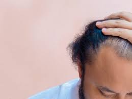 The before and after images provide a good indication about the. Thinning Hair In Men 11 Tips To Treat And Cover Hair Loss
