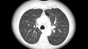 Image result for Emphysema