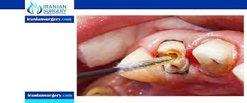 If you have pain after root canal treatment that persists for more than a few days or you feel is too severe to be treated otc, you should contact your dentist. Pain After Root Canal