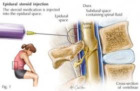 How many spinal epidurals can you have in a year? Epidural Corticosteroids For Sciatica Are They Safe And Effective Consider Chiropractic Care Back Resort