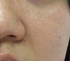 Toner lah yg menutup semula liang roma terbuka waktu kita cuci muka tadi. Vitamin Sana Sini Cara Kecilkan Liang Pori Terbuka Yang Selamat Dan Sangat Berbaloi