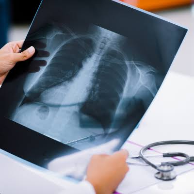 X-Ray