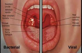 Medically known as group a streptococcus, this is a bacterial infection that leads to inflammation of the throat. Bacterial Vs Viral Sore Throat Throat Infection Strep Throat Treatment For Sore Throat