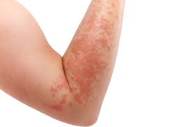 Image result for allergy rash on the legs