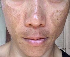 Melasma causes dark patches to appear on the skin. Melasma