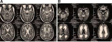 Tro name meaning, armenian baby boy name tro meaning,etymology, history, presonality details. Reversible Hypoxic Brain Injury The Penumbra Conundrum Of Grinker Bmj Case Reports