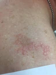 Granuloma annulare is frequently of obscure etiology most normally showing on the hands and feet. Granuloma Annulare Pennsylvania Dermatology Specialists