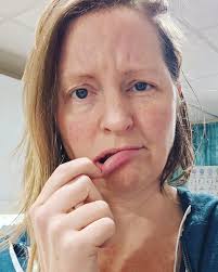 When should I be concerned about a gum bump after sinus infection?