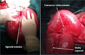 Image result for Sigmoid Volvulus