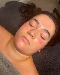 Charlotte Rye (@charlotteryeskin) · Meopham